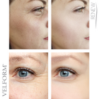Tratamiento Facial Antiaging con Colágeno + Ácido Hialurónico