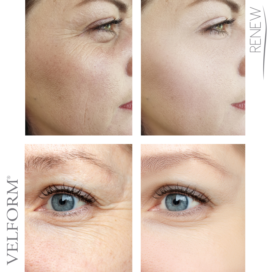 Tratamiento Facial Antiaging con Colágeno + Ácido Hialurónico